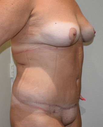 Massive Weight Loss : Case 85 - After