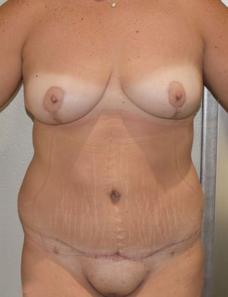 Massive Weight Loss : Case 85 - After