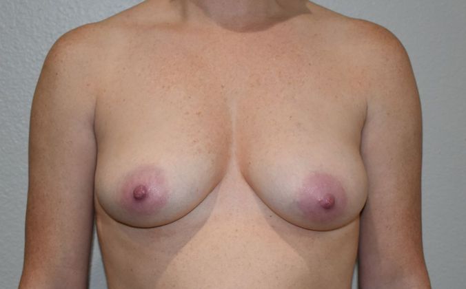 Breast Augmentation w/ Lift: Case 373 - Before