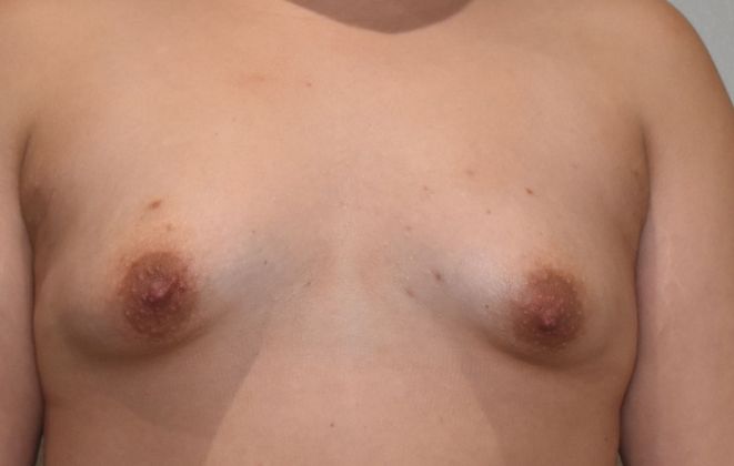 Breast Augmentation Case 646 - Before
