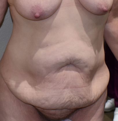 Tummy Tuck (Abdominoplasty): Case 298 - Before