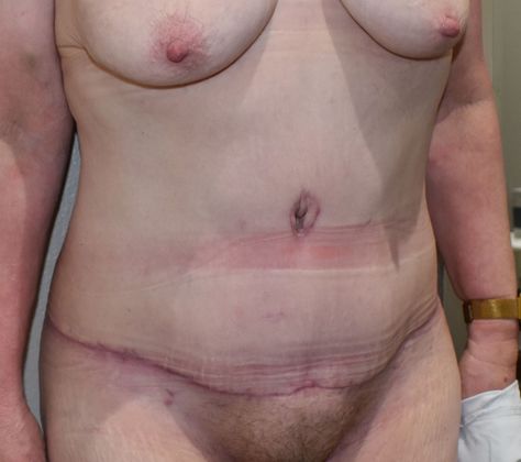 Tummy Tuck (Abdominoplasty): Case 298 - After