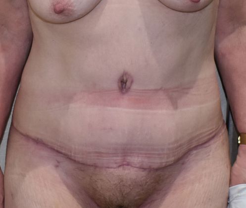 Tummy Tuck (Abdominoplasty): Case 298 - After