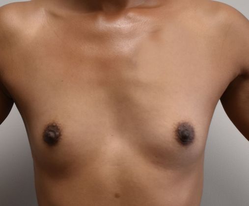Breast Augmentation Case 648 - Before
