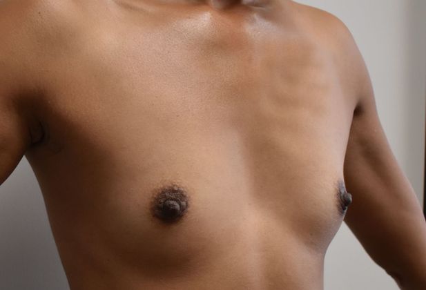 Breast Augmentation: Case 648 - Before