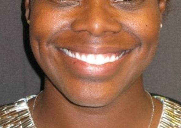 Dimple creation Case 1 - After