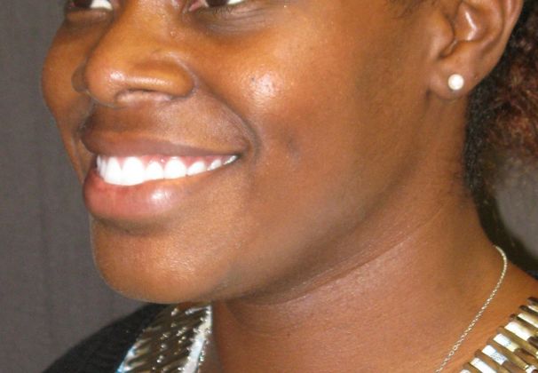 Dimple creation: Case 1 - After