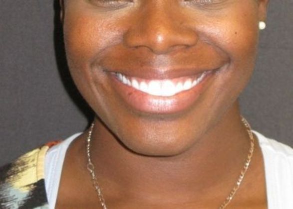 Dimple creation Case 1 - Before