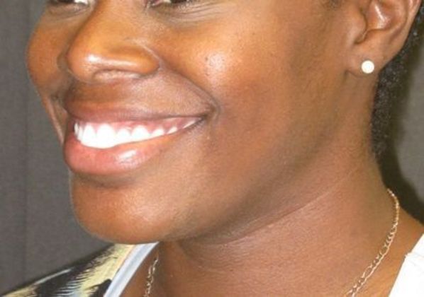 Dimple creation: Case 1 - Before