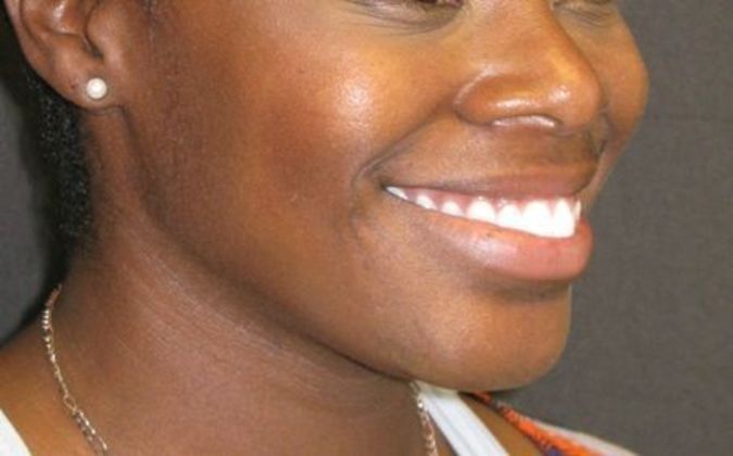 Dimple creation: Case 1 - Before