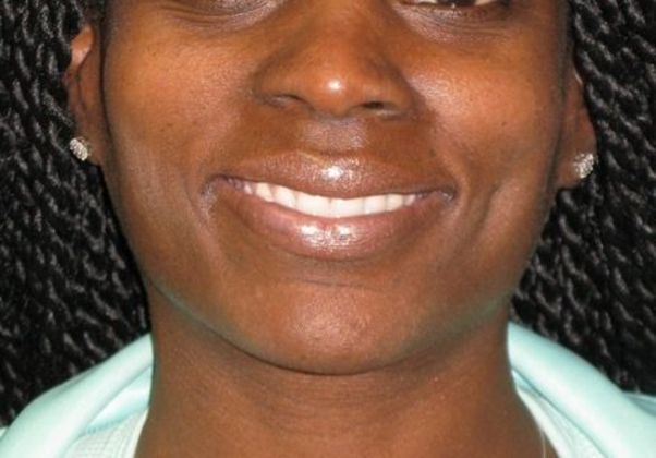 Dimple creation Case 2 - After