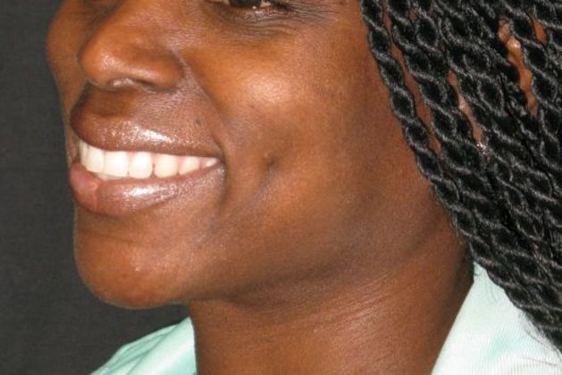 Dimple creation: Case 2 - After