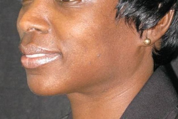 Dimple creation: Case 2 - Before