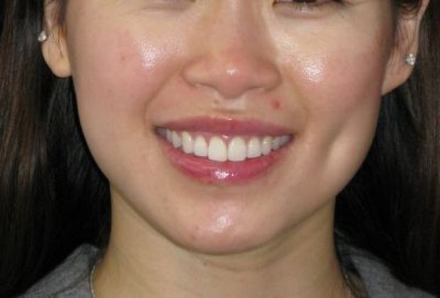 Dimple creation Case 3 - After