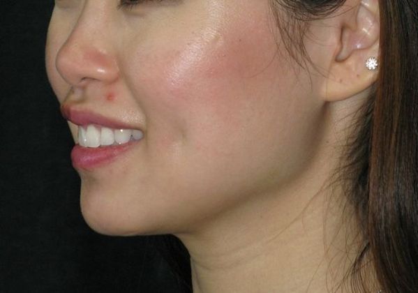 Dimple creation: Case 3 - After