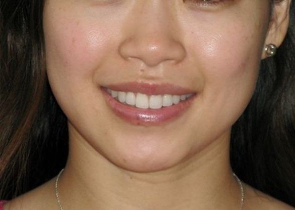 Dimple creation Case 3 - Before