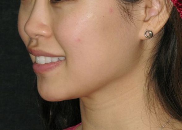 Dimple creation: Case 3 - Before