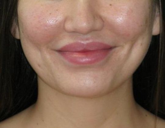 Dimple creation Case 4 - After