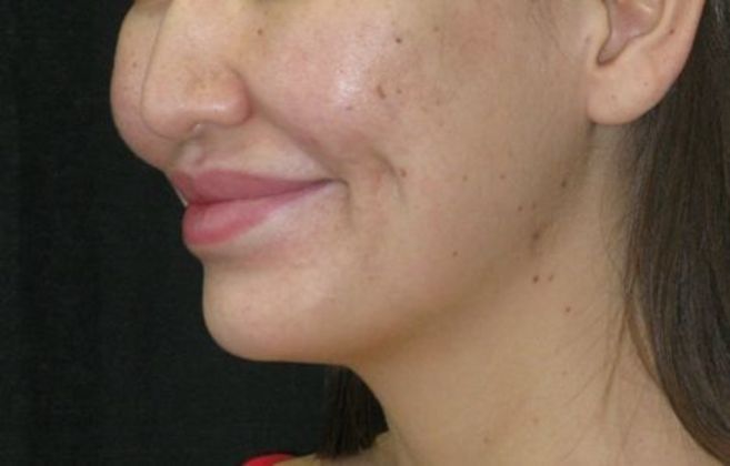 Dimple creation: Case 4 - After