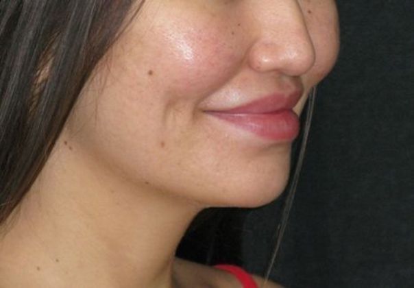 Dimple creation: Case 4 - After