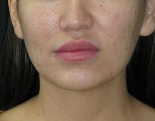 Dimple creation Case 4 - Before