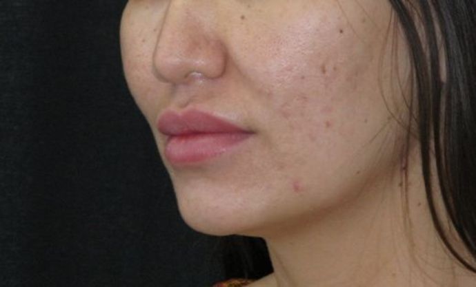 Dimple creation: Case 4 - Before