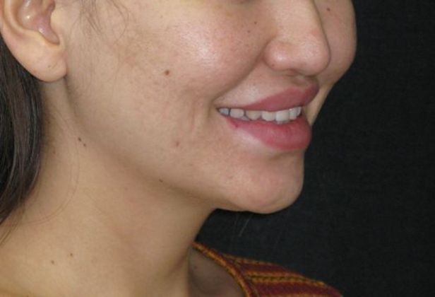 Dimple creation: Case 4 - Before