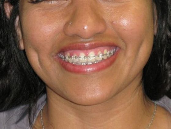 Dimple creation Case 5 - After