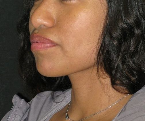 Dimple creation: Case 5 - After