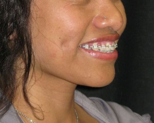 Dimple creation: Case 5 - After