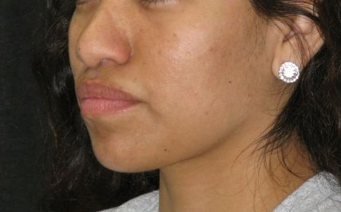 Dimple creation: Case 5 - Before