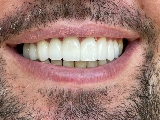 Case 1 after smile makeover