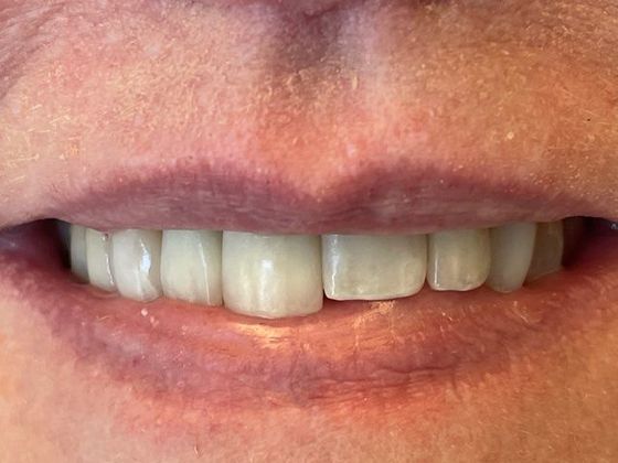 Smile Makeovers Case 11 - Before