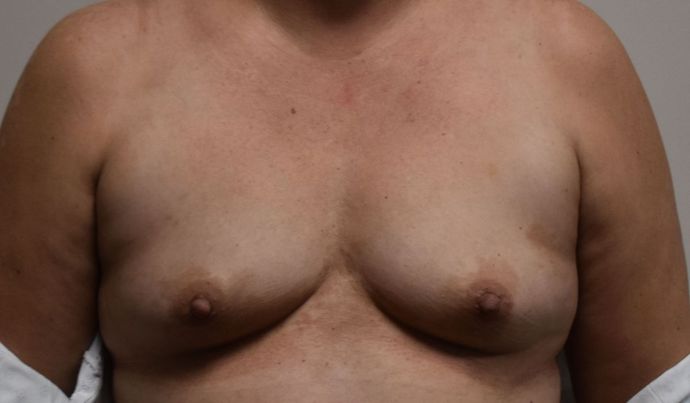 Breast Augmentation Case 649 - Before