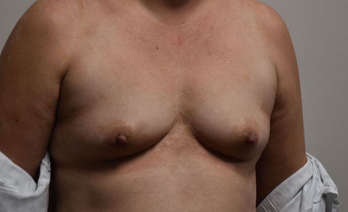 Breast Augmentation: Case 649 - Before