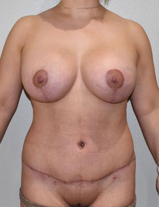 Mommy Makeover Case 197 - After