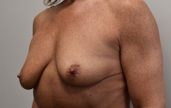 Breast Augmentation w/ Lift: Case 380 - Before