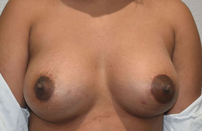 Breast Augmentation Case 652 - After
