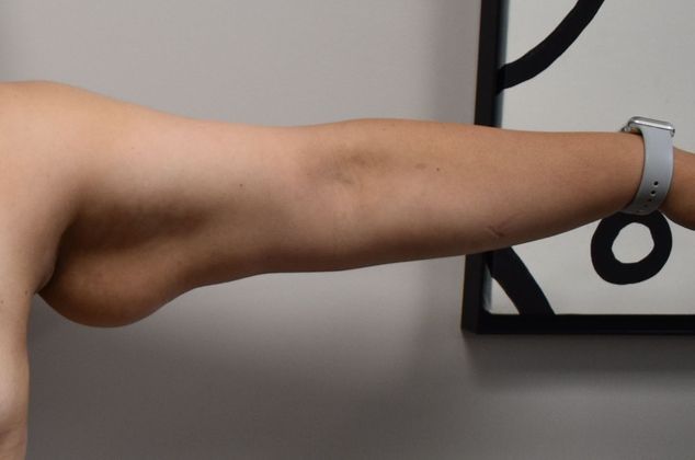 Brachioplasty Case 16 - Before