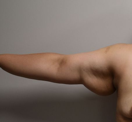 Brachioplasty: Case 16 - Before