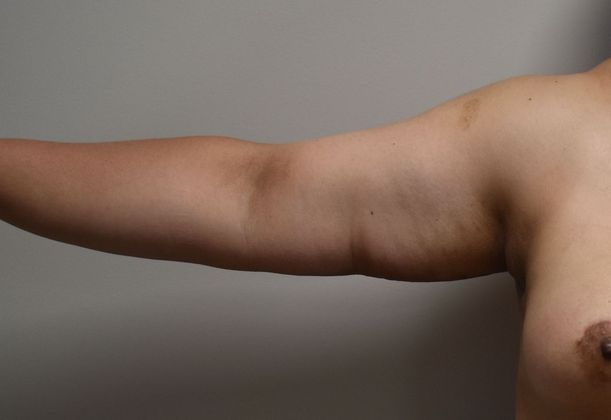 Brachioplasty: Case 16 - After