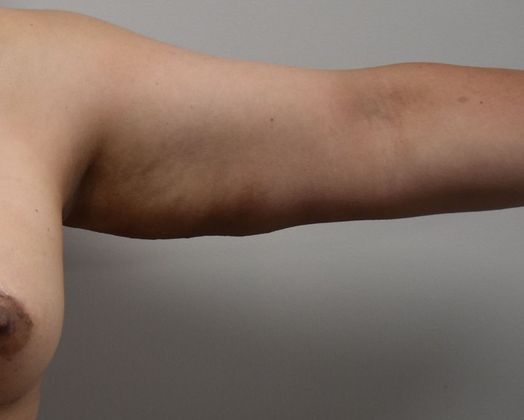 Brachioplasty Case 16 - After