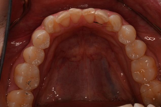 Invisalign: Case 18 - Lower teeth before invisalgin