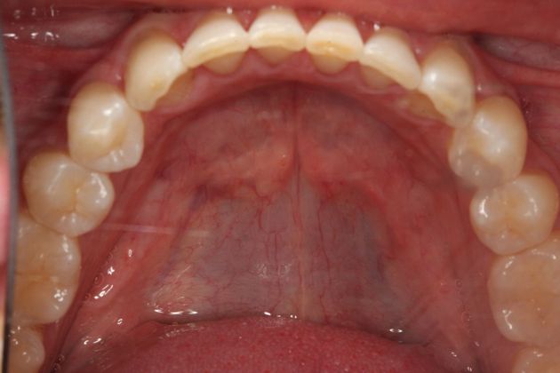 Invisalign: Case 18 - Lower teeth after invisalgin