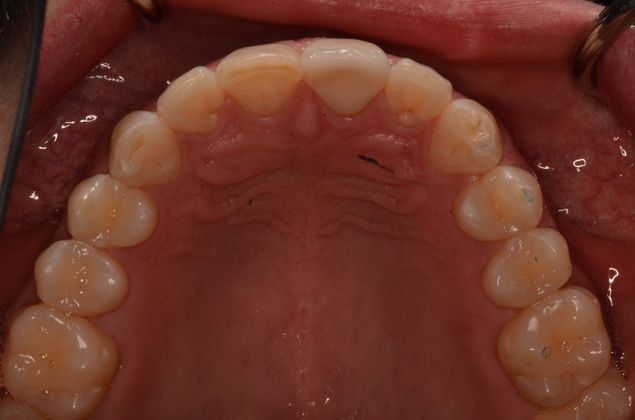 Invisalign: Case 18 - upper teeth after invisalign