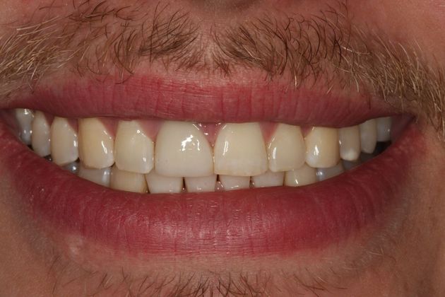 Invisalign: Case 18 - After invisalign (orthodontics)