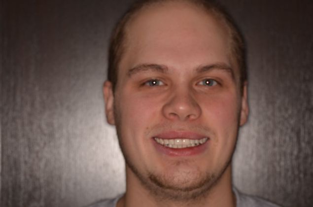 Invisalign: Case 18 - After invisalign (orthodontics)