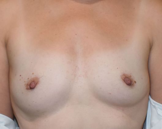 Breast Augmentation Case 655 - Before