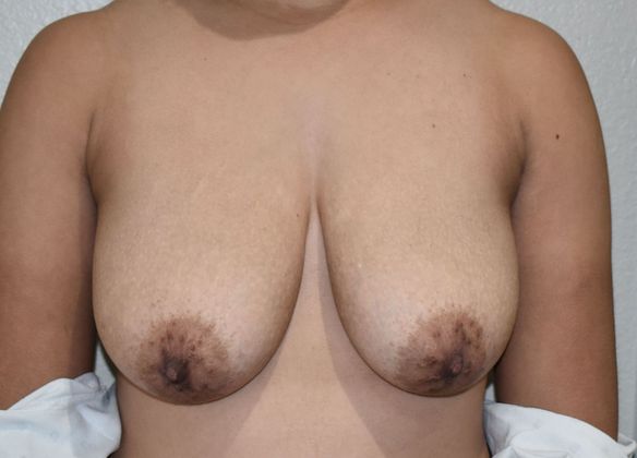 Breast Lift (Mastopexy) Case 124 - Before