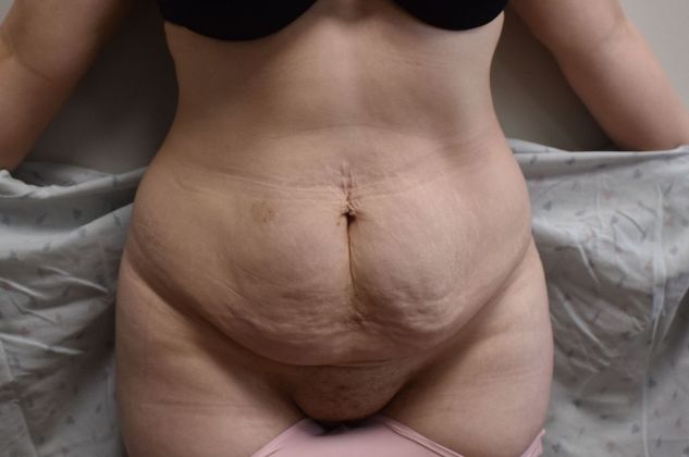 Tummy Tuck (Abdominoplasty): Case 305 - Before